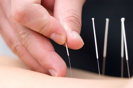 ฝังเข็ม (Acupuncture)