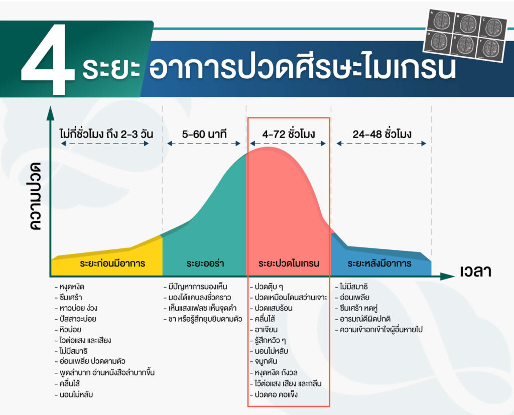 4 ระยะปวดหัวไมเกรน